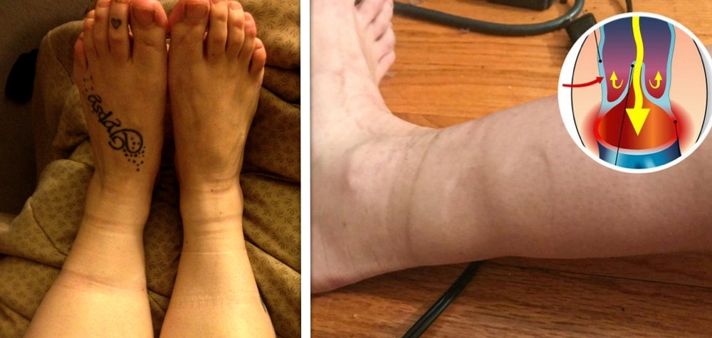 sock-indentation-socks-leave-marks-on-legs-causes-and-treatment