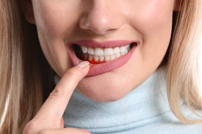 Home Remedies For Bleeding Gums