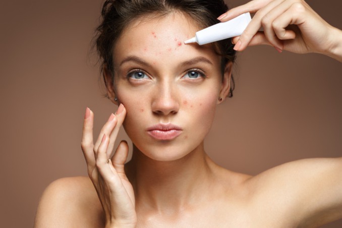 Winter Acne, What Is It And How Is It Treated?